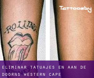 Eliminar tatuajes en Aan de Doorns (Western Cape)