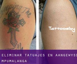Eliminar tatuajes en Aangewysd (Mpumalanga)