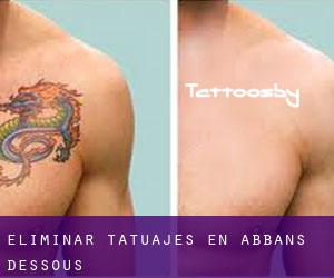 Eliminar tatuajes en Abbans-Dessous