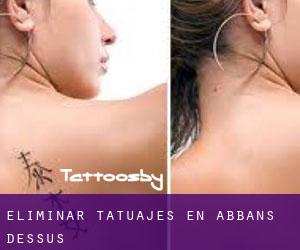 Eliminar tatuajes en Abbans-Dessus