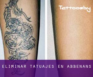 Eliminar tatuajes en Abbenans