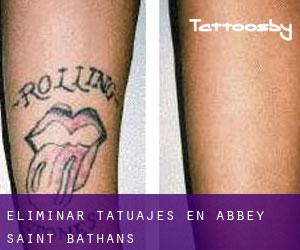 Eliminar tatuajes en Abbey Saint Bathans