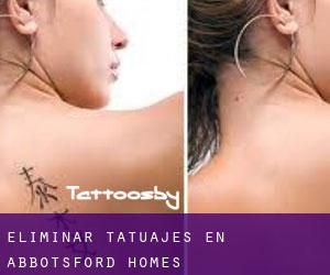 Eliminar tatuajes en Abbotsford Homes