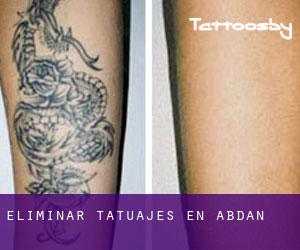 Eliminar tatuajes en Abdan