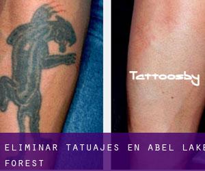 Eliminar tatuajes en Abel Lake Forest
