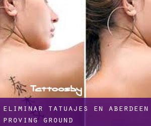 Eliminar tatuajes en Aberdeen Proving Ground