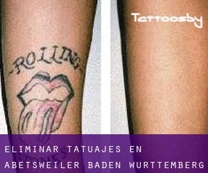 Eliminar tatuajes en Abetsweiler (Baden-Württemberg)