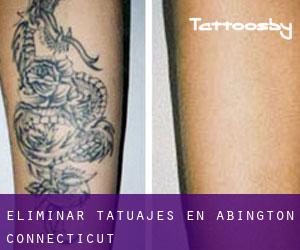 Eliminar tatuajes en Abington (Connecticut)