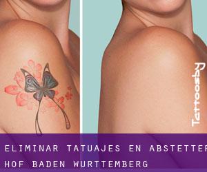 Eliminar tatuajes en Abstetter Hof (Baden-Württemberg)