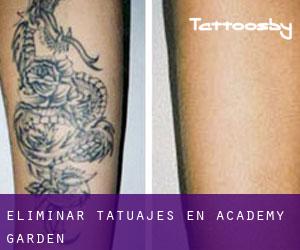 Eliminar tatuajes en Academy Garden