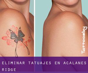Eliminar tatuajes en Acalanes Ridge