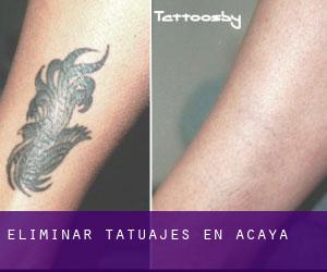 Eliminar tatuajes en Acaya