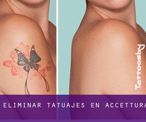 Eliminar tatuajes en Accettura