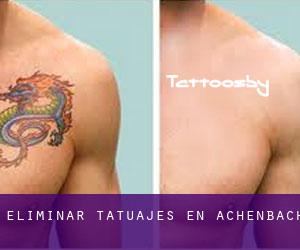 Eliminar tatuajes en Achenbach