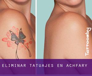Eliminar tatuajes en Achfary
