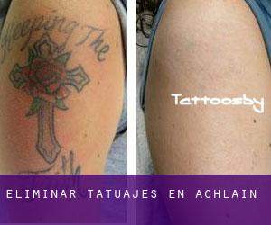 Eliminar tatuajes en Achlain