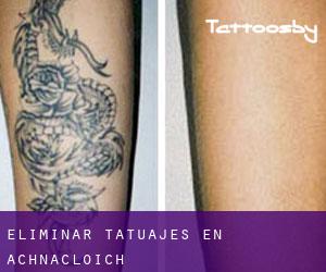 Eliminar tatuajes en Achnacloich