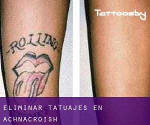 Eliminar tatuajes en Achnacroish