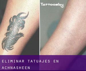 Eliminar tatuajes en Achnasheen