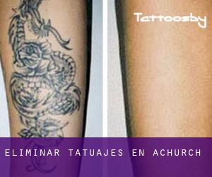 Eliminar tatuajes en Achurch