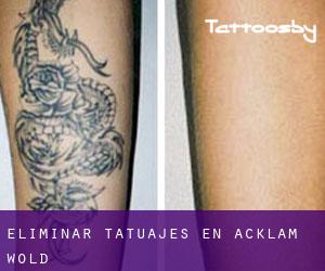Eliminar tatuajes en Acklam Wold