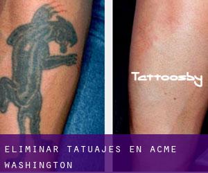 Eliminar tatuajes en Acme (Washington)