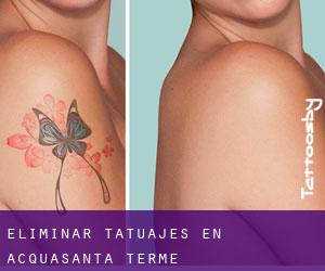 Eliminar tatuajes en Acquasanta Terme