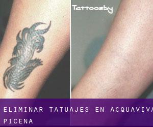 Eliminar tatuajes en Acquaviva Picena