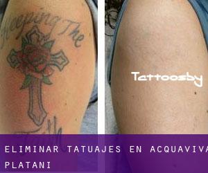Eliminar tatuajes en Acquaviva Platani