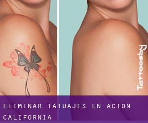 Eliminar tatuajes en Acton (California)