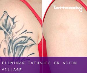 Eliminar tatuajes en Acton Village