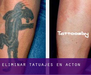 Eliminar tatuajes en Acton