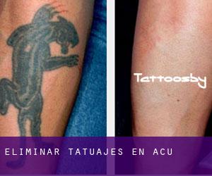 Eliminar tatuajes en Açu