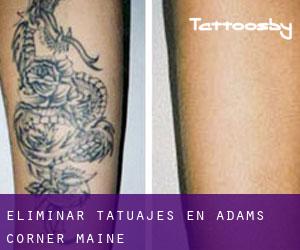 Eliminar tatuajes en Adams Corner (Maine)