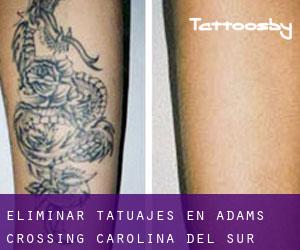 Eliminar tatuajes en Adams Crossing (Carolina del Sur)