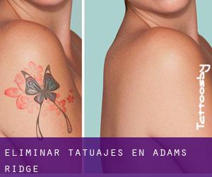 Eliminar tatuajes en Adams Ridge