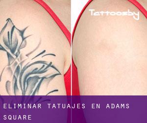 Eliminar tatuajes en Adams Square
