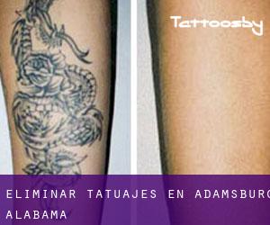 Eliminar tatuajes en Adamsburg (Alabama)