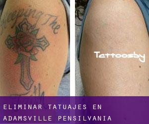 Eliminar tatuajes en Adamsville (Pensilvania)