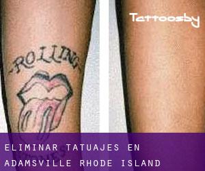 Eliminar tatuajes en Adamsville (Rhode Island)