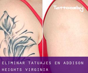 Eliminar tatuajes en Addison Heights (Virginia)