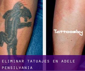 Eliminar tatuajes en Adele (Pensilvania)