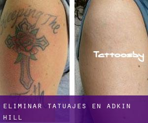 Eliminar tatuajes en Adkin Hill