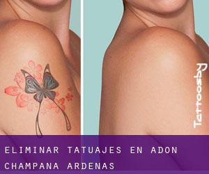Eliminar tatuajes en Adon (Champaña-Ardenas)