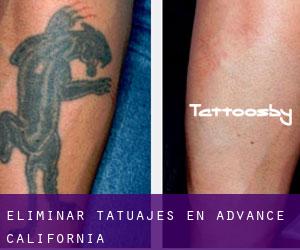 Eliminar tatuajes en Advance (California)