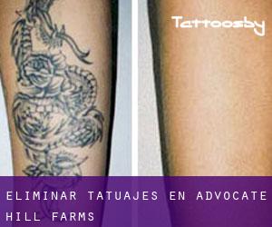 Eliminar tatuajes en Advocate Hill Farms
