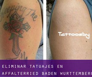Eliminar tatuajes en Affalterried (Baden-Württemberg)