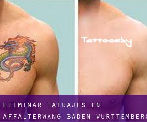 Eliminar tatuajes en Affalterwang (Baden-Württemberg)