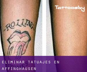 Eliminar tatuajes en Affinghausen