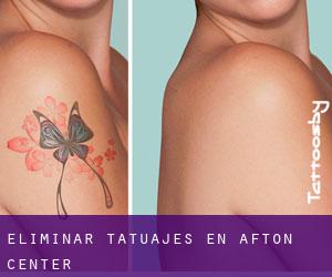 Eliminar tatuajes en Afton Center